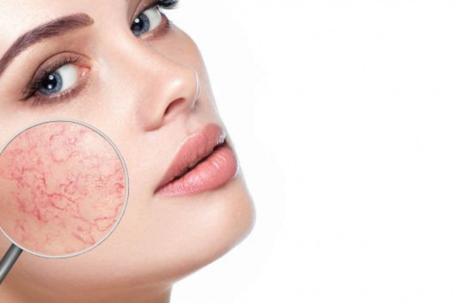 Beauty reporter: Nega osetljive kože lica